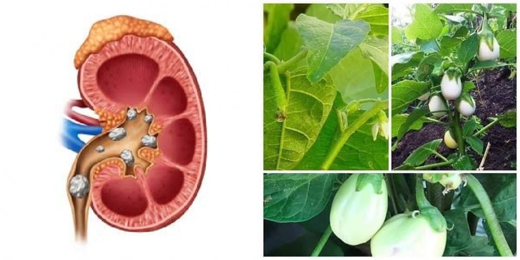 Can garden egg leaf cure kidney stone?