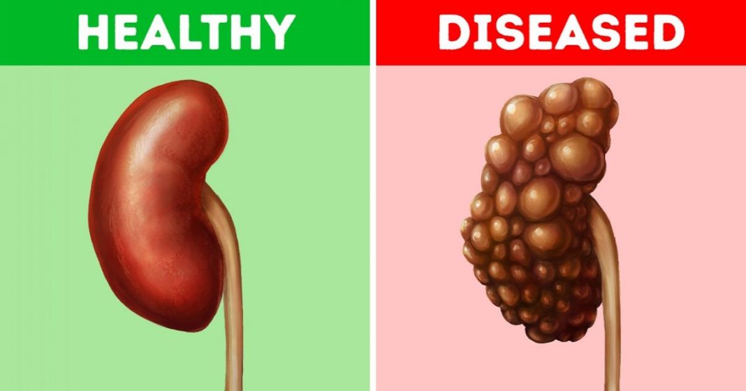 Kidney diseases in Nigeria Causes of kidney disease in Nigeria