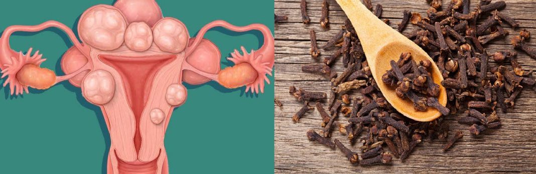 Does cloves shrink fibroid? Does cloves shrink fibroid?