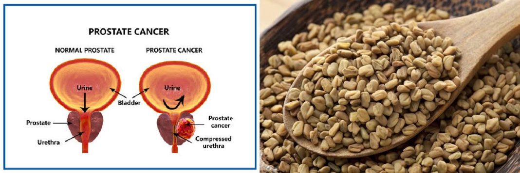 Fenugreek and Enlarged Prostate:Is fenugreek good for prostate cancer? Fenugreek and Enlarged Prostate:Is fenugreek good for prostate cancer?