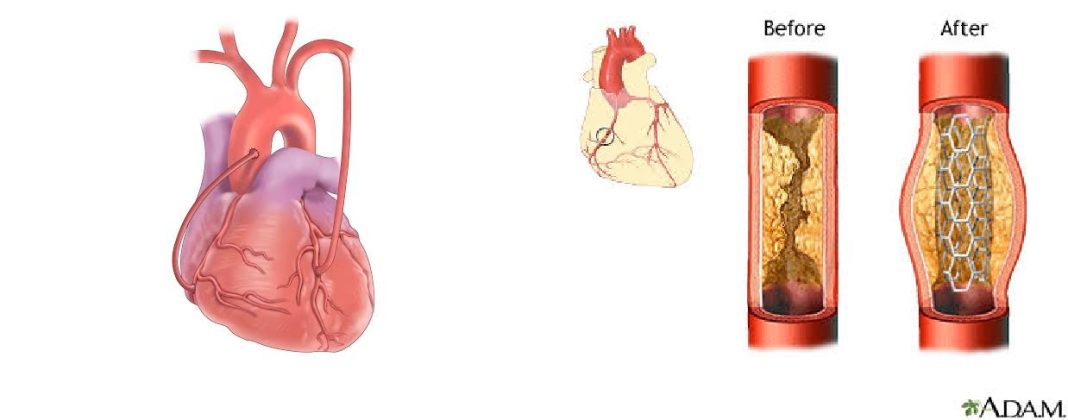 Bypass surgery or stent which is better? Bypass surgery or stent which is better?
