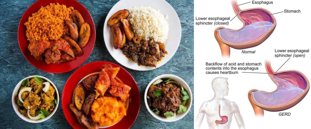 Nigerian diet for acid reflux Nigerian diet for acid reflux