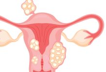 Do fibroids have a heartbeat? Do fibroids have a heartbeat?