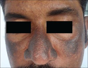 Why does hydroquinone make skin darker ?