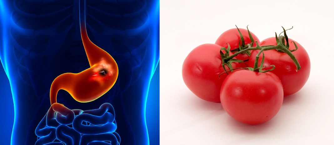 Is tomatoes good or bad for gastritis or stomach ulcer? Is tomatoes good or bad for gastritis or stomach ulcer?