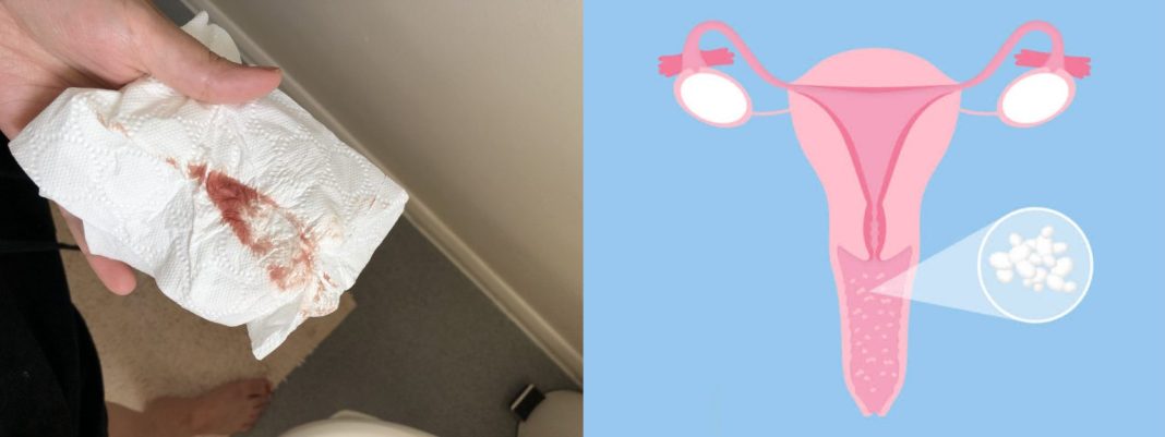 can yeast infection cause miscarriage in early Pregnancy? can yeast infection cause miscarriage in early Pregnancy?