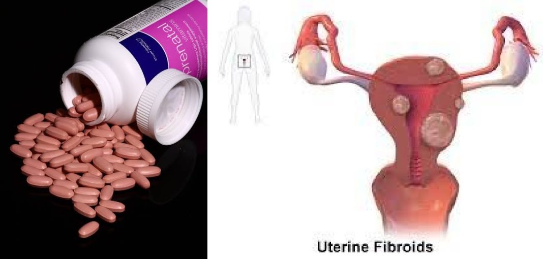 Prenatal vitamins and fibroid Can prenatal vitamins cause fibroids to grow?