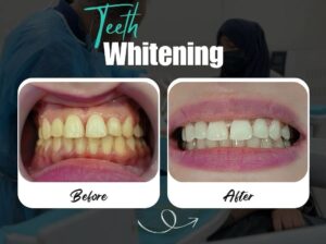 Is teeth whitening permanent?