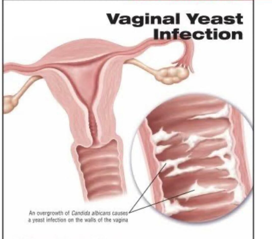 Yeast infection Vaginal Candidiasis