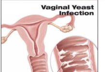 Vaginal Candidiasis – symptoms, causes, treatment and prevention Vaginal Candidiasis
