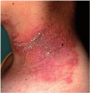 A victim of Skirt and Blouse insect bite