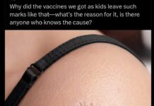 Why does BCG vaccine leave a scar? Why does BCG vaccine leave a scar?