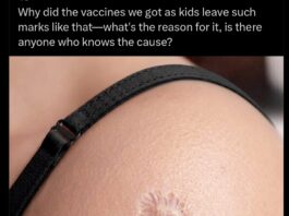 Why does BCG vaccine leave a scar? Why does BCG vaccine leave a scar?