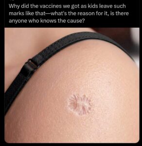 Why does BCG vaccine leave a scar?