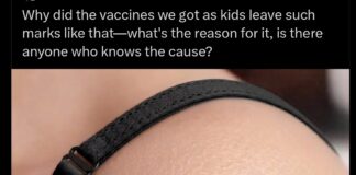 Why does BCG vaccine leave a scar? Why does BCG vaccine leave a scar?