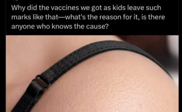 Why does BCG vaccine leave a scar? Why does BCG vaccine leave a scar?