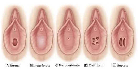 Vagina atresia
