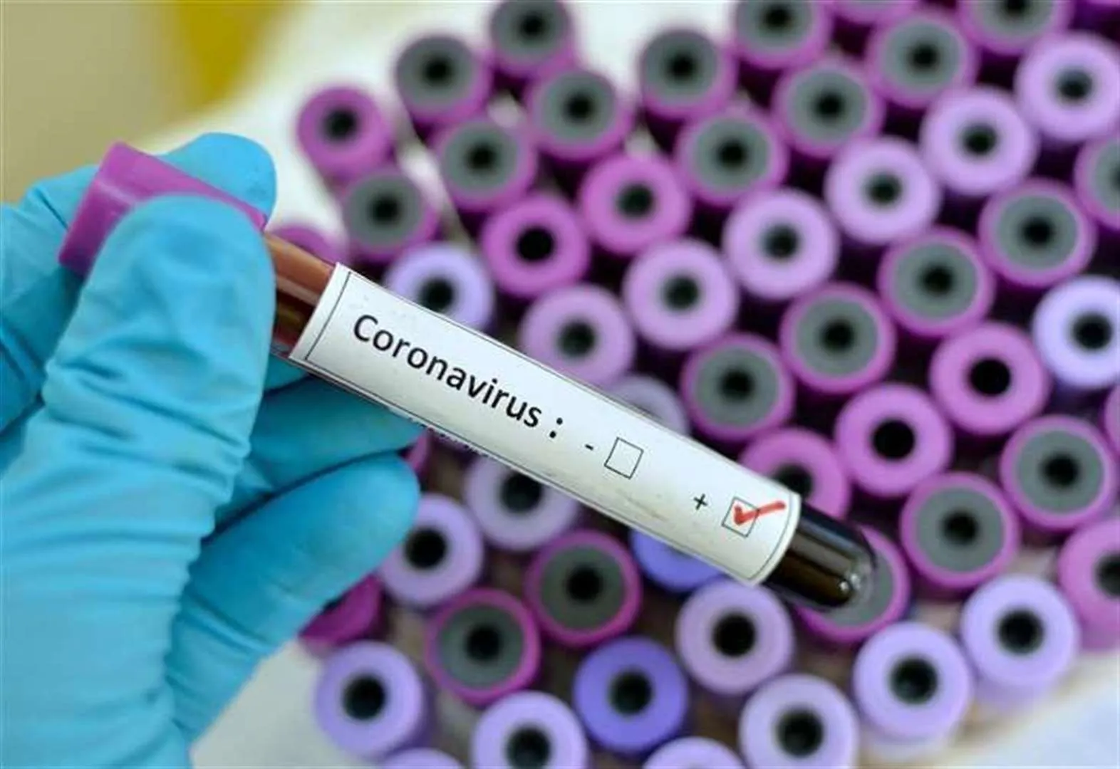 FLASH: 15 doctors tests positive for coronavirus in Kano 15 doctors tests positive for coronavirus in Kano