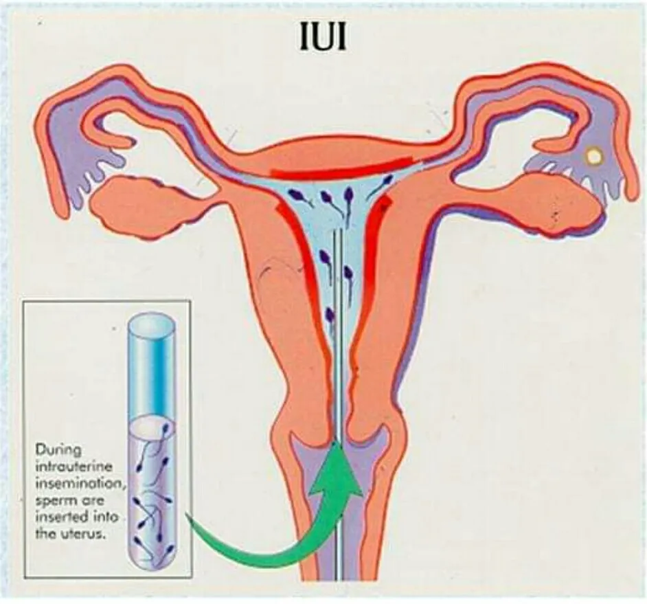 IUI treatment cost in Nigeria