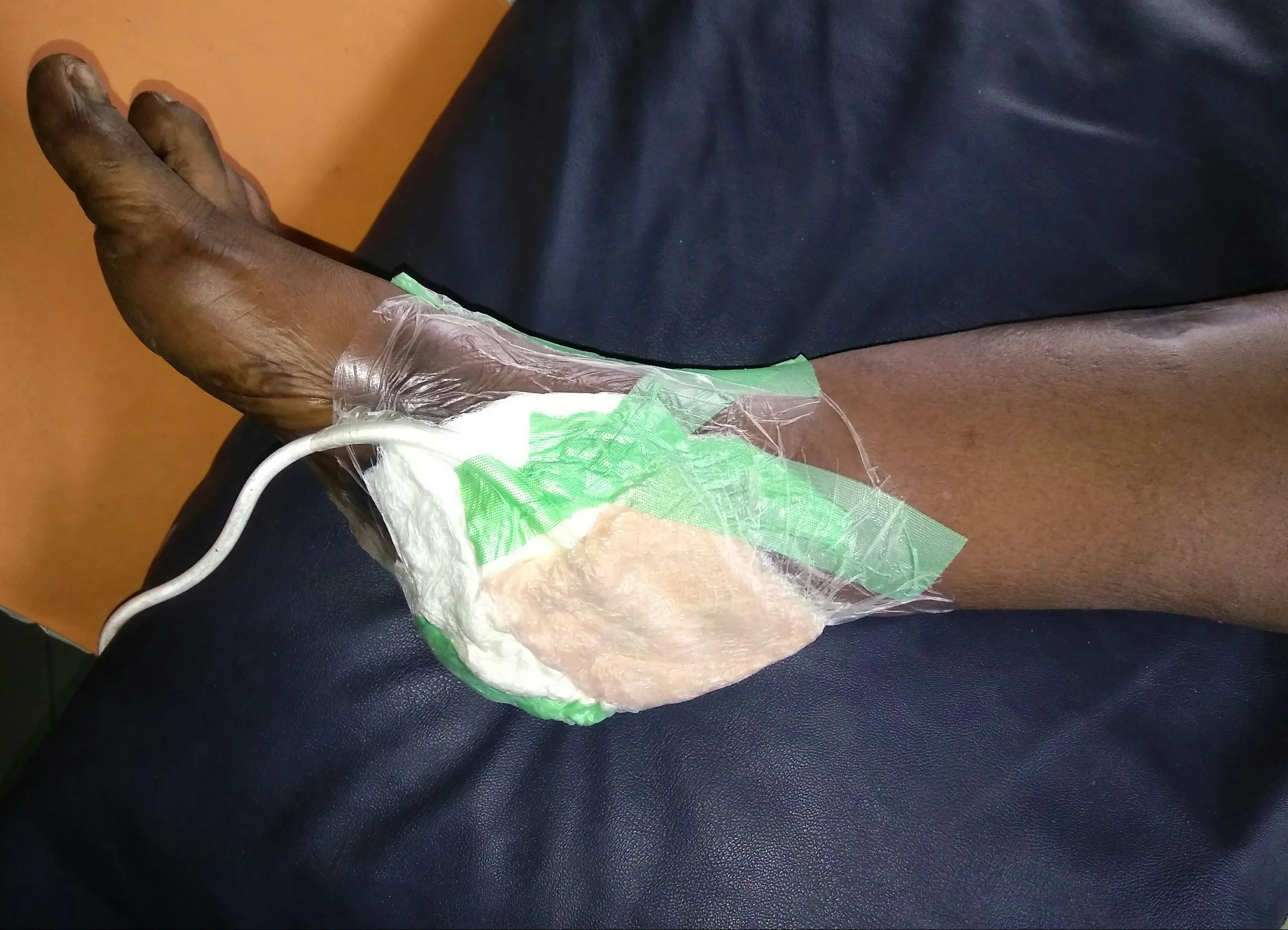 Wound Care: A Comprehensive Article on Negative Pressure Wound Therapy (NPWT) Wound Care: Applying Negative Pressure Wound Therapy(NPWT) for a leg ulcer