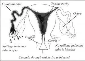 HSG test cost in Ghana (See Price of Hysterosalpingogram in Ghana) HSG test cost in Ghana (See Price of Hysterosalpingogram in Ghana)