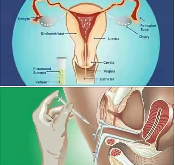 Cost of IUI in Ghana + IUI Centers in Ghana