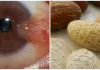Can bitter kola cure pterygium? (Bitter Kola and Eye Problems)