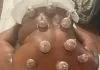 15 Cupping Therapy Benefits – Does cupping work? Cupping Therapy Benefits